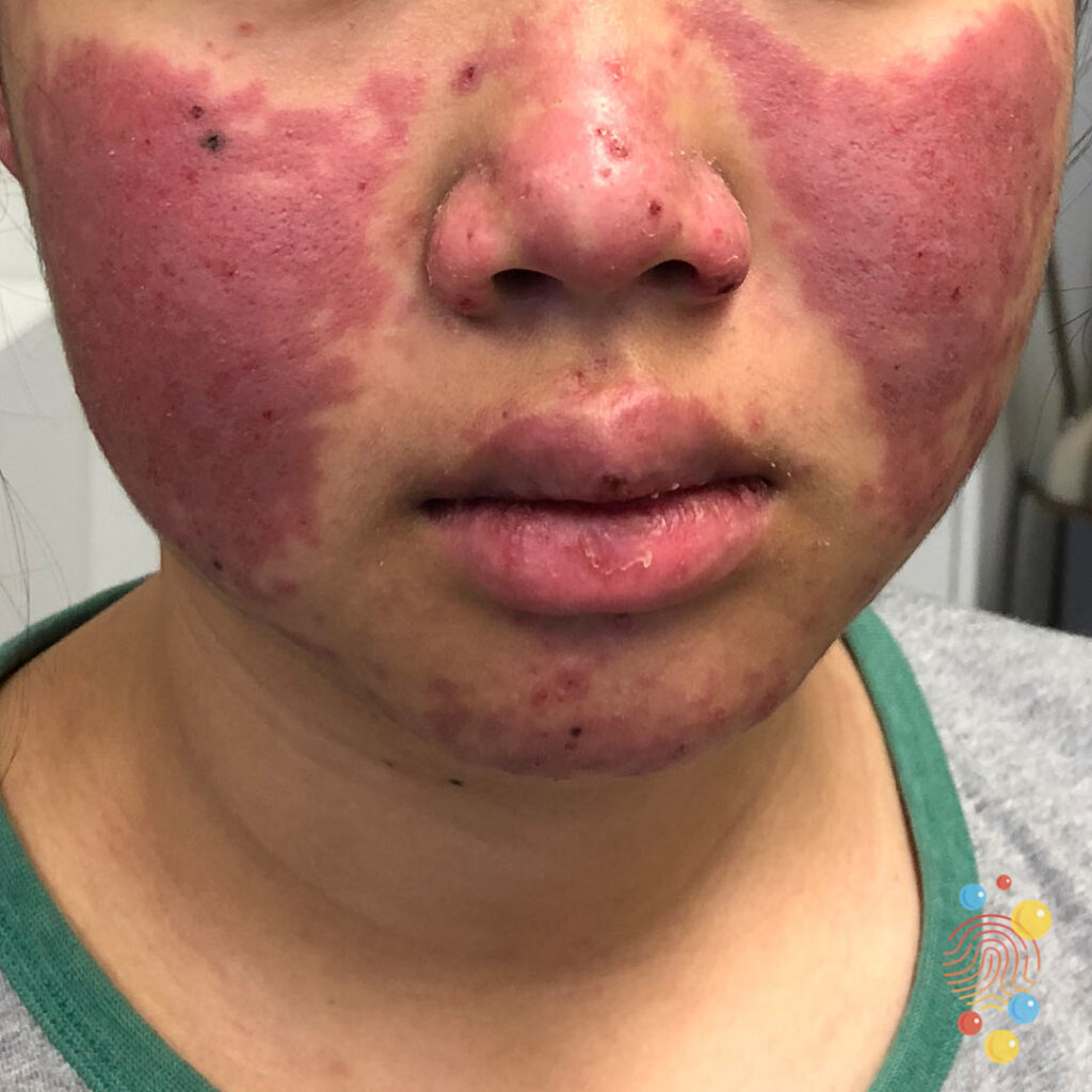 Lupus(SLE)